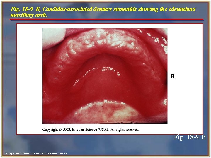 Fig. 18 -9 B, Candidas-associated denture stomatitis showing the edentulous maxillary arch. Fig. 18