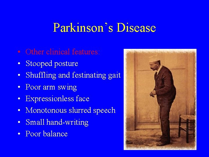 Parkinson’s Disease • • Other clinical features: Stooped posture Shuffling and festinating gait Poor