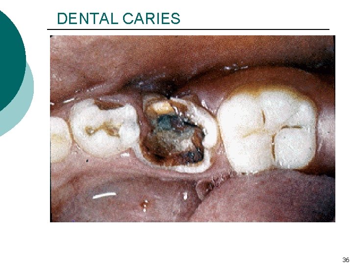 DENTAL CARIES 36 