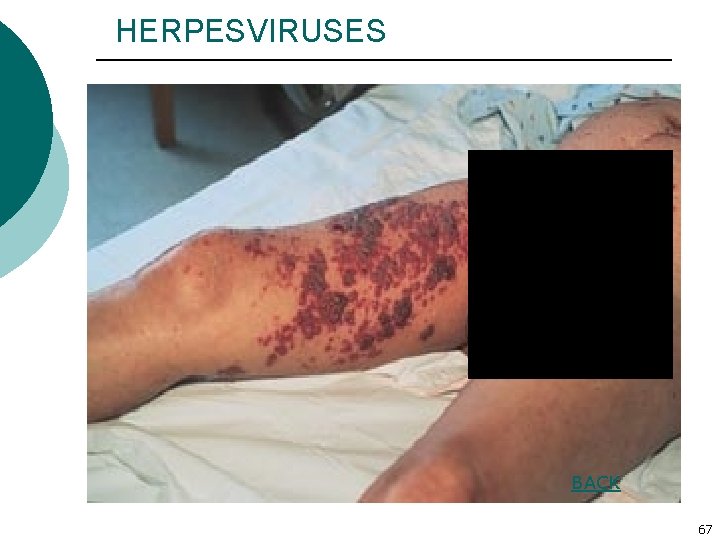 HERPESVIRUSES BACK 67 