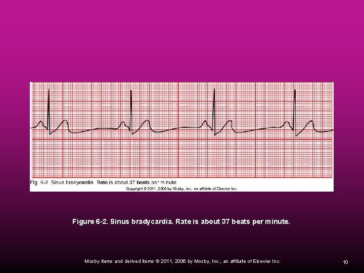 Figure 6 -2. Sinus bradycardia. Rate is about 37 beats per minute. Mosby items