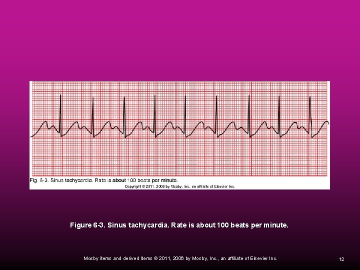 Figure 6 -3. Sinus tachycardia. Rate is about 100 beats per minute. Mosby items