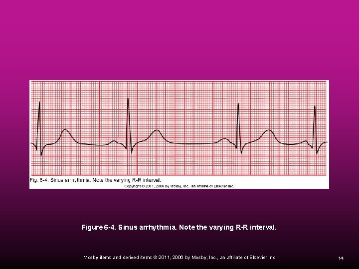Figure 6 -4. Sinus arrhythmia. Note the varying R-R interval. Mosby items and derived