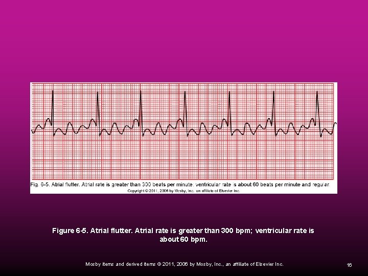 Figure 6 -5. Atrial flutter. Atrial rate is greater than 300 bpm; ventricular rate