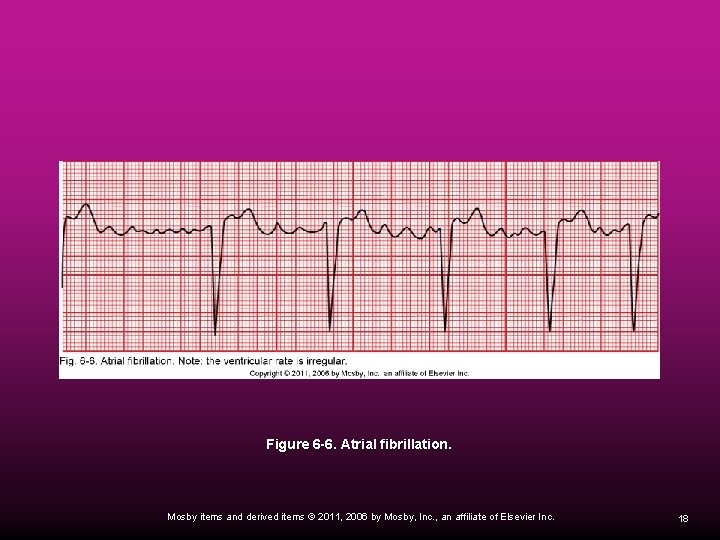 Figure 6 -6. Atrial fibrillation. Mosby items and derived items © 2011, 2006 by