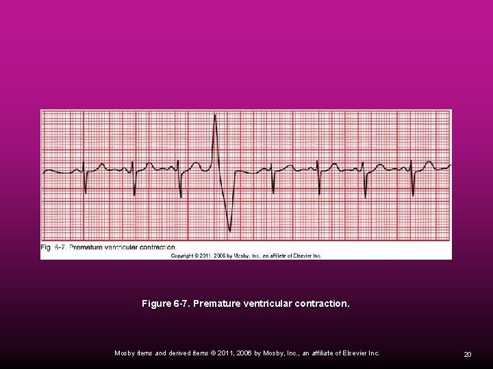 Figure 6 -7. Premature ventricular contraction. Mosby items and derived items © 2011, 2006