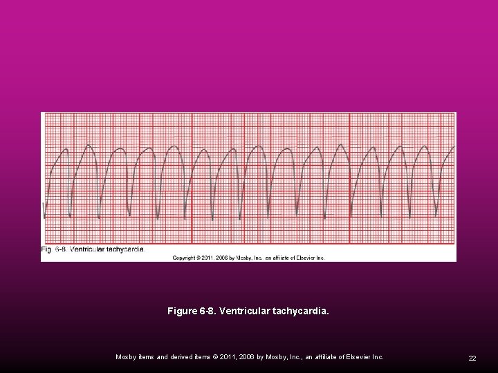 Figure 6 -8. Ventricular tachycardia. Mosby items and derived items © 2011, 2006 by
