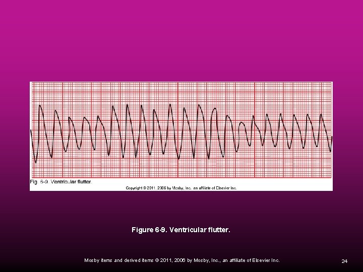 Figure 6 -9. Ventricular flutter. Mosby items and derived items © 2011, 2006 by