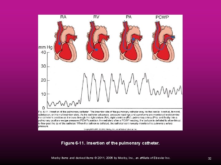 Figure 6 -11. Insertion of the pulmonary catheter. Mosby items and derived items ©