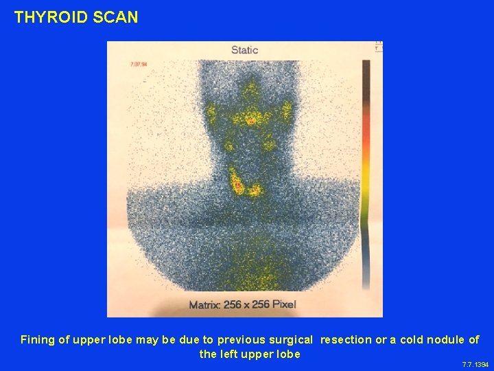 THYROID SCAN Fining of upper lobe may be due to previous surgical resection or