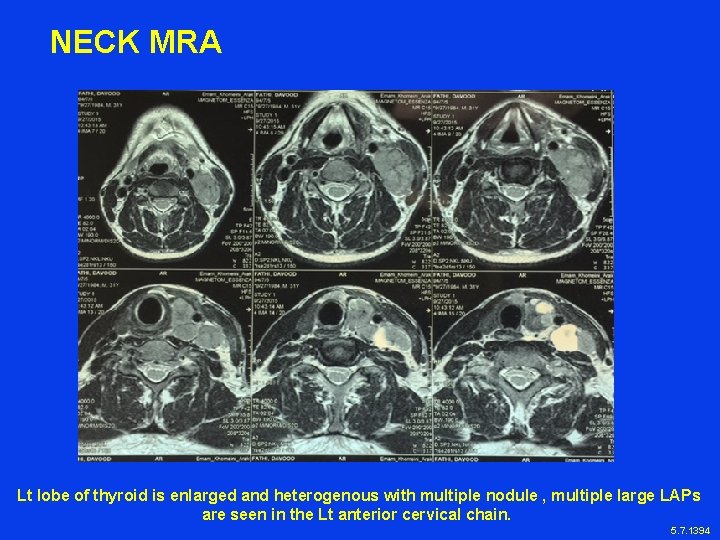 NECK MRA Lt lobe of thyroid is enlarged and heterogenous with multiple nodule ,