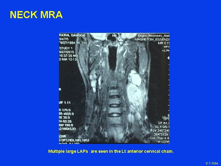 NECK MRA Multiple large LAPs are seen in the Lt anterior cervical chain. 5.