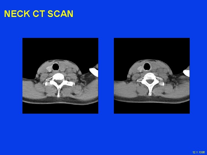 NECK CT SCAN 12. 1. 1395 