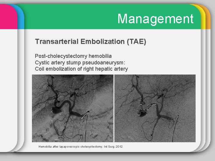Management Transarterial Embolization (TAE) Post-cholecystectomy hemobilia Cystic artery stump pseudoaneurysm: Coil embolization of right