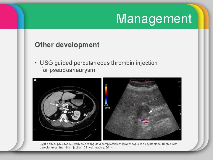 Management Other development • USG guided percutaneous thrombin injection for pseudoaneurysm Cystic artery pseudoaneurysm