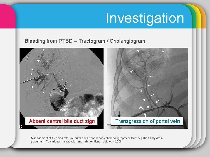 Investigation Bleeding from PTBD – Tractogram / Cholangiogram Absent central bile duct sign Transgression