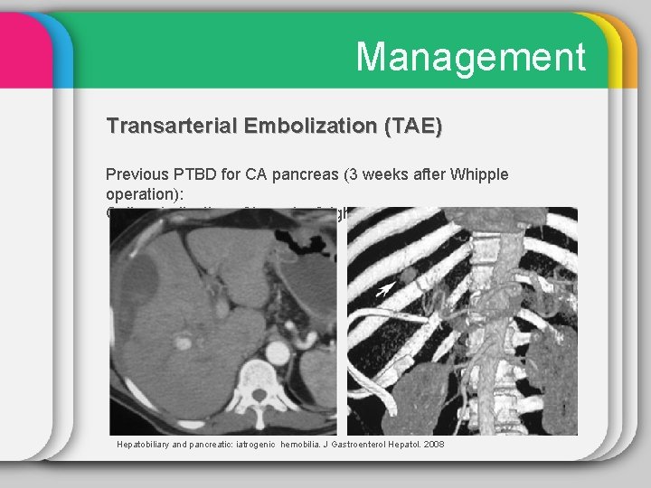Management Transarterial Embolization (TAE) Previous PTBD for CA pancreas (3 weeks after Whipple operation):