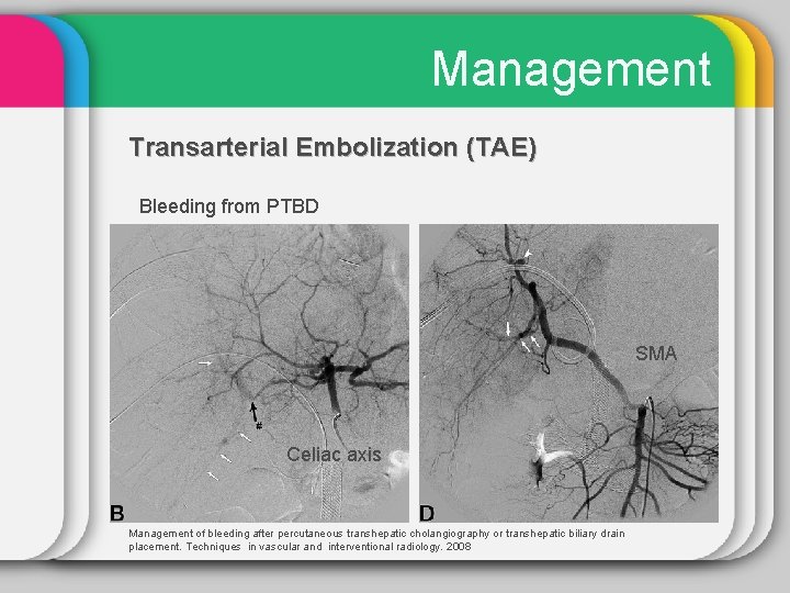 Management Transarterial Embolization (TAE) Bleeding from PTBD SMA Celiac axis Management of bleeding after