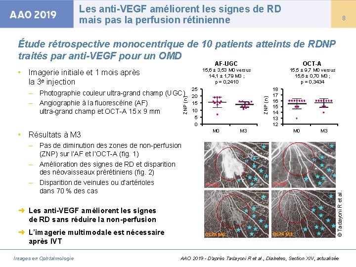 Les anti-VEGF améliorent les signes de RD mais pas la perfusion rétinienne 8 Étude