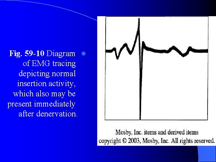 Fig. 59 -10 Diagram l of EMG tracing depicting normal insertion activity, which also