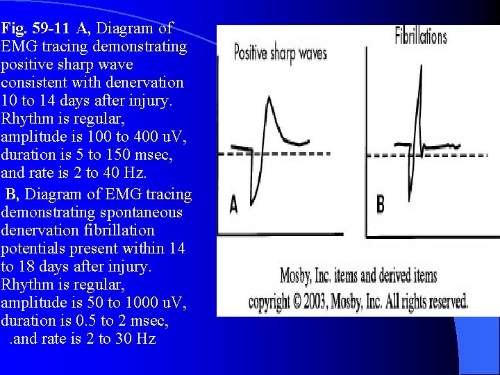 Fig. 59 -11 A, Diagram of EMG tracing demonstrating positive sharp wave consistent with