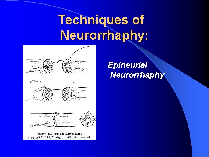 Techniques of Neurorrhaphy: Epineurial Neurorrhaphy 