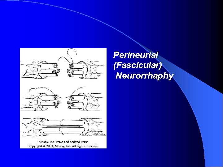 Perineurial (Fascicular) Neurorrhaphy 