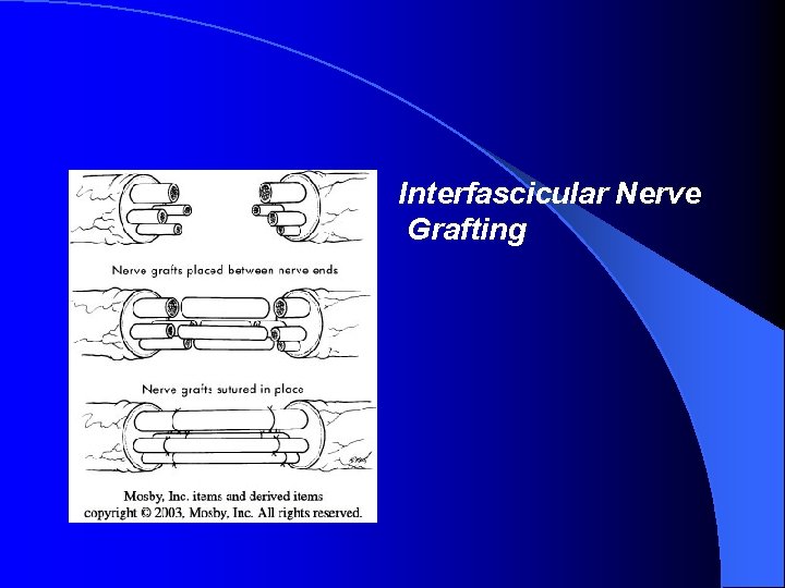 Interfascicular Nerve Grafting 