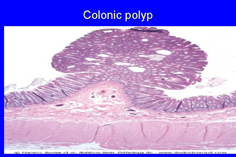 Colonic polyp 