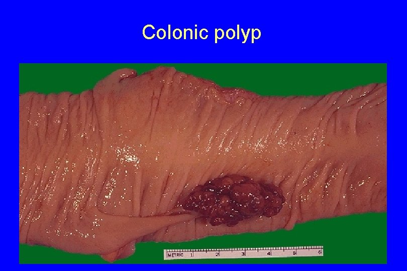 Colonic polyp 13 