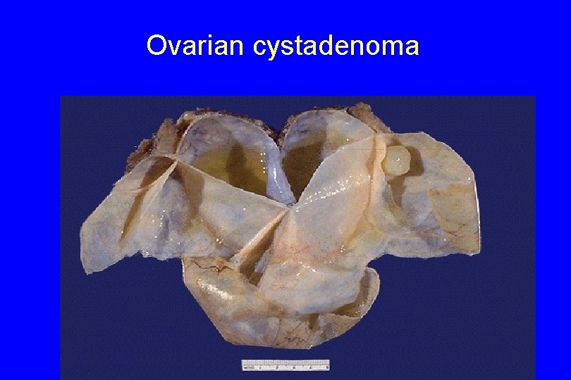 Ovarian cystadenoma 14 