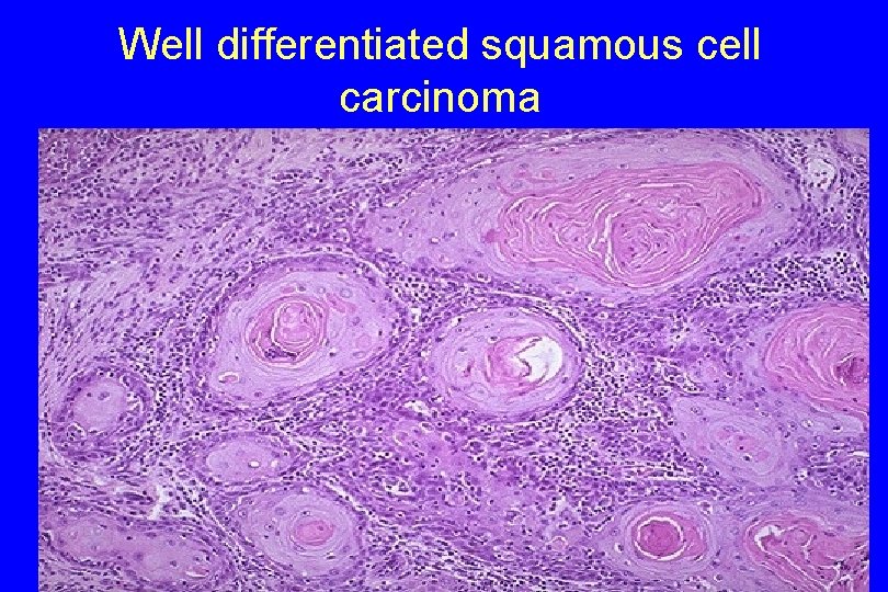 Well differentiated squamous cell carcinoma 19 