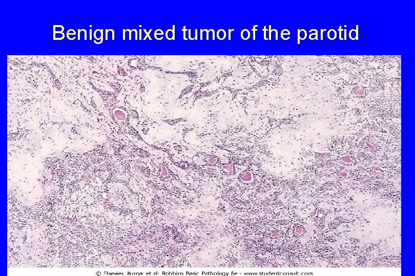 Benign mixed tumor of the parotid 