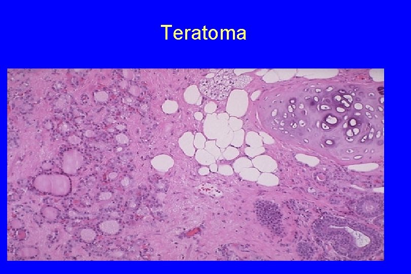 Teratoma 25 