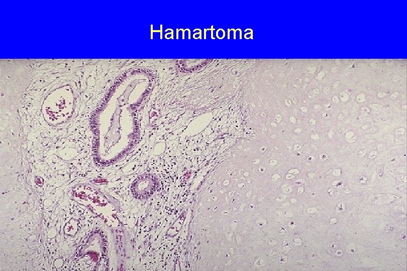 Hamartoma 28 