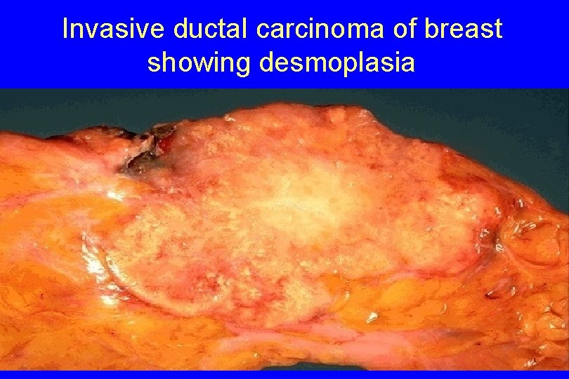 Invasive ductal carcinoma of breast showing desmoplasia 