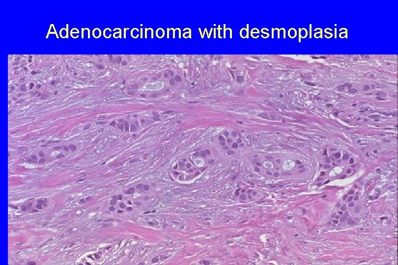 Adenocarcinoma with desmoplasia 35 