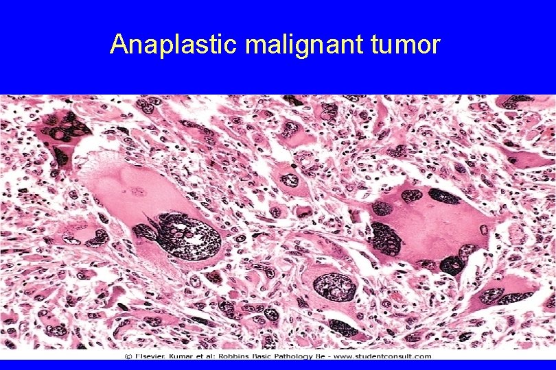 Anaplastic malignant tumor 