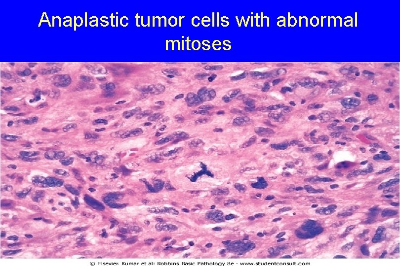 Anaplastic tumor cells with abnormal mitoses 