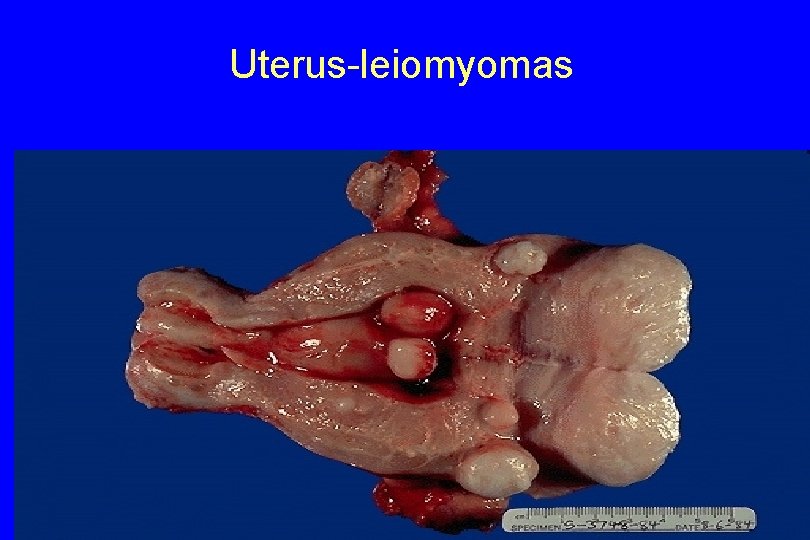 Uterus-leiomyomas 