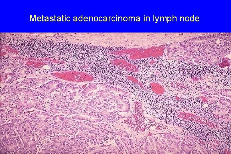 Metastatic adenocarcinoma in lymph node 