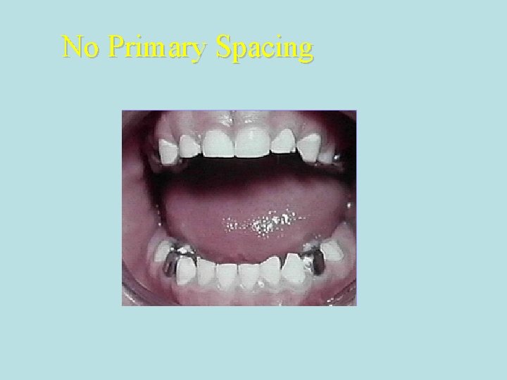 No Primary Spacing No Primary Spacing