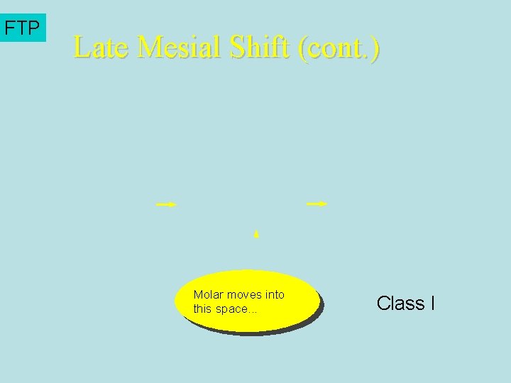 FTP Late Mesial Shift (cont. ) Molar moves into this space. . . Class FTP Late Mesial Shift (cont. ) Molar moves into this space. . . Class