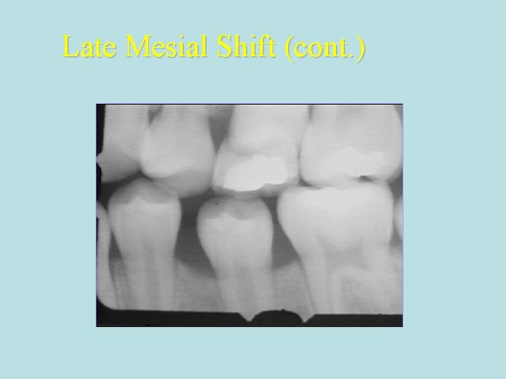 Late Mesial Shift (cont. ) 