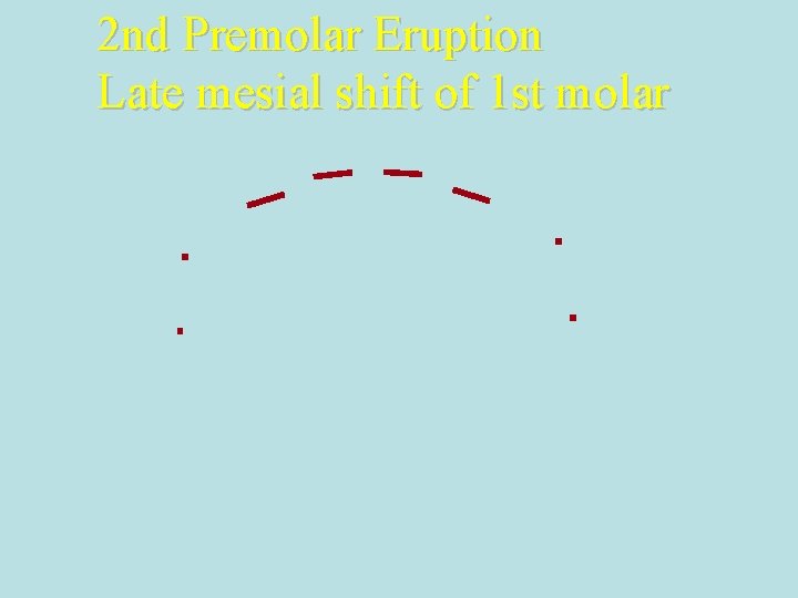 2 nd Premolar Eruption Late mesial shift of 1 st molar 
