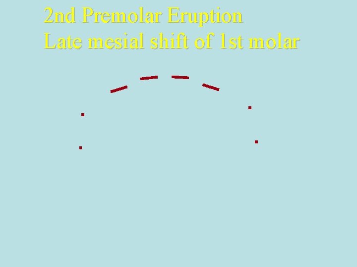2 nd Premolar Eruption Late mesial shift of 1 st molar 2 nd Premolar Eruption Late mesial shift of 1 st molar