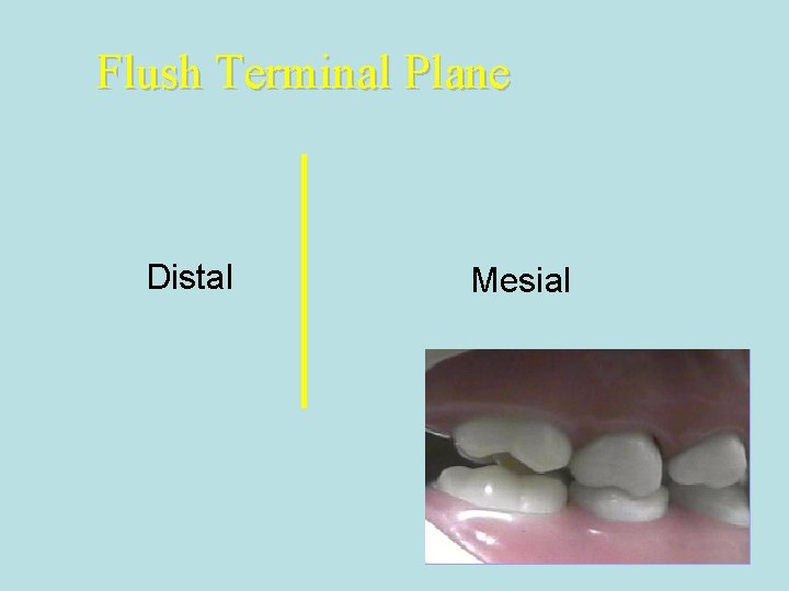 Flush Terminal Plane Distal Mesial 