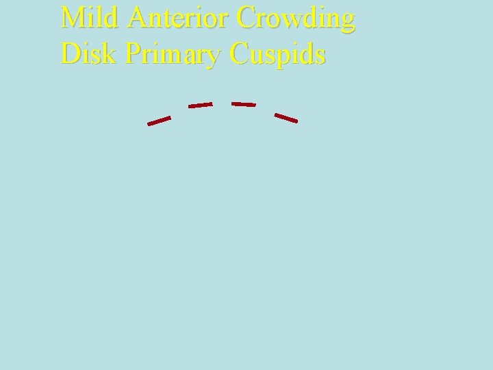 Mild Anterior Crowding Disk Primary Cuspids 
