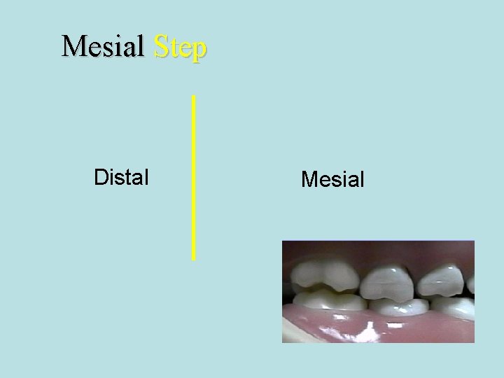Mesial Step Distal Mesial 