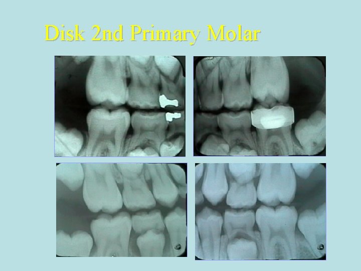 Disk 2 nd Primary Molar 